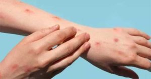 Mpox : मंकीपॉक्सचा वाढता संसर्ग; WHO कडून 'हेल्थ इमरजेंसीची' घोषणा!