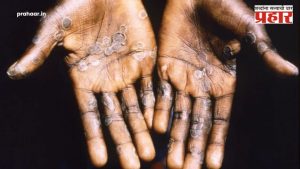 Monkeypox Outbreak: सावधान! जगभरात मंकीपॉक्सचा कहर! जाणून घ्या लक्षणे अन् उपाय