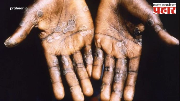 Monkeypox Outbreak: सावधान! जगभरात मंकीपॉक्सचा कहर! जाणून घ्या लक्षणे अन् उपाय