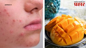 Simple Tricks For Pimple : आंबा खाल्ल्यावर चेहऱ्यावर पिंपल्स येतात? मग 'या' टिप्स आहेत बेस्ट