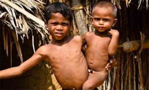 मुंबईत तीव्र कुपोषित बालकांची संख्या चिंताजनक