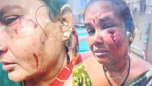 मुंबईतील गोरेगावमध्ये भटक्या कुत्र्यांच्या टोळीने तोडले महिलांच्या गालांचे लचके