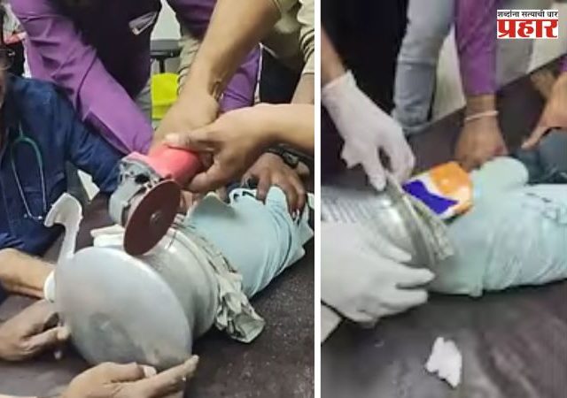 Jalgaon: चिमुकलीचं डोकं अडकलं भांड्यात; ११ मिनिटांच्या अथक प्रयत्नानंतर डॉक्टरांना यश