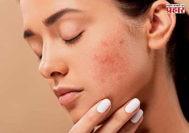 Pimple Solution : चेहऱ्यावर वारंवार पिंपल्स येतात? 'या' सोप्या उपायांनी मिळवा स्वच्छ, नितळ त्वचा